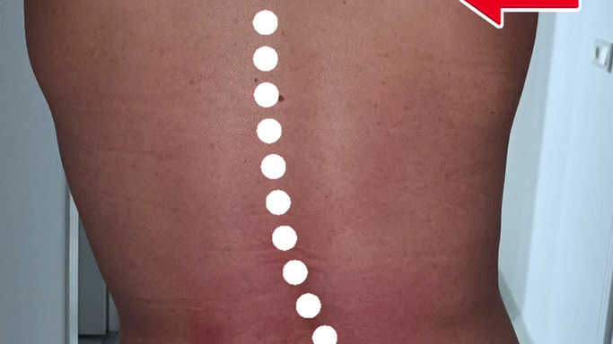 Bel fıtığı ve Antaljik postür